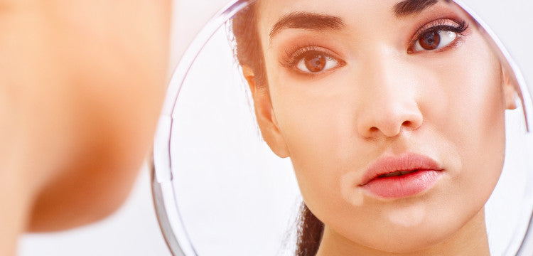 Mi az a vitiligo?