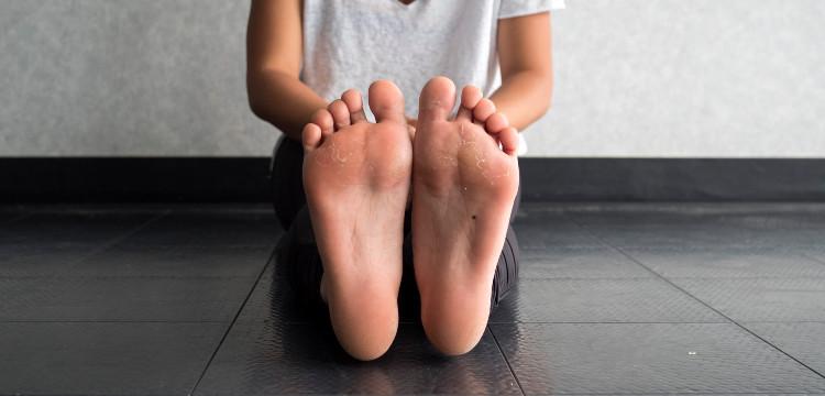 Hogyan kezelhető a bőrkeményedés? Mutatjuk a lehetőségeket!