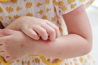 Szúnyogcsípés allergia – Hogyan védhetjük meg magunkat?