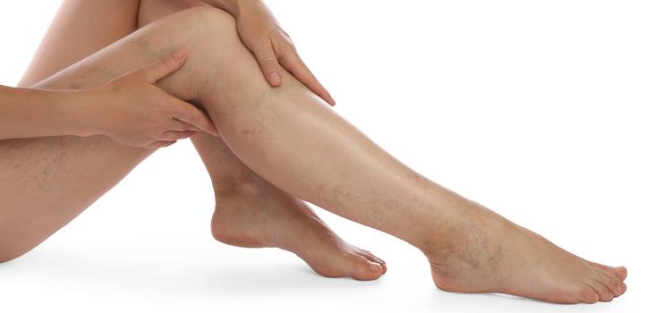 Egyre romló visszeres panaszok?