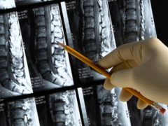 A csontritkulás megelőzése