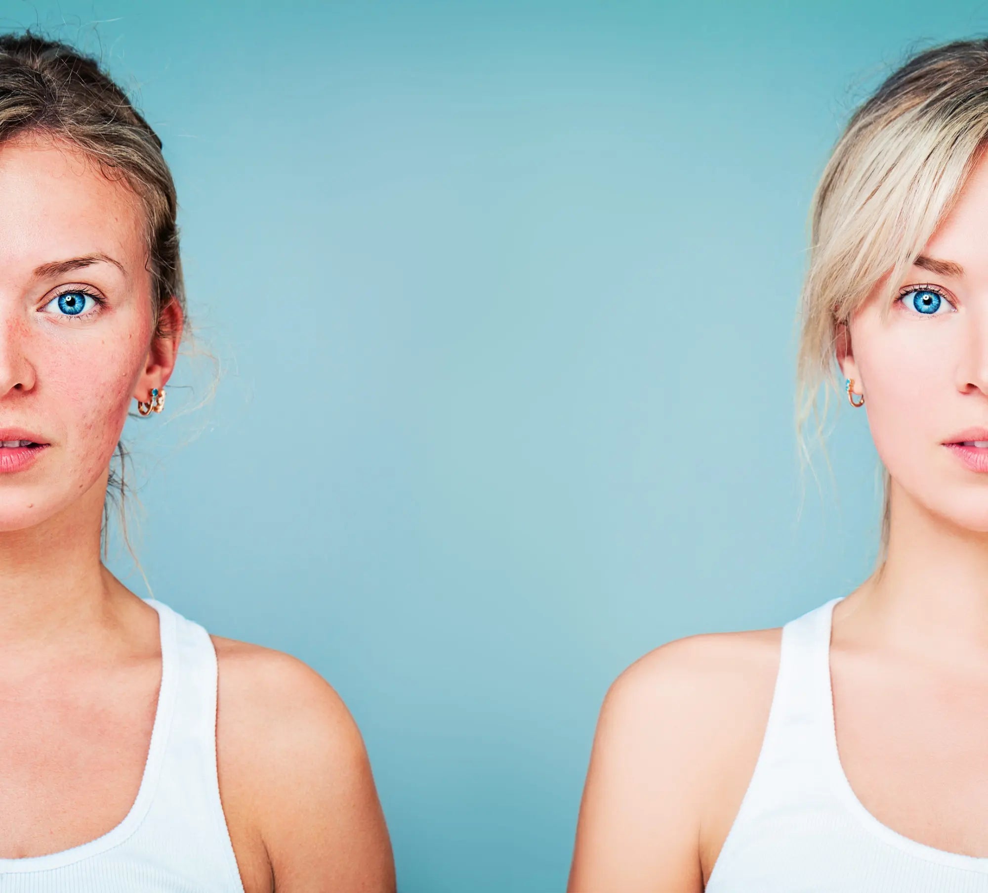 Mi az a rosacea és hogyan kezelhető?