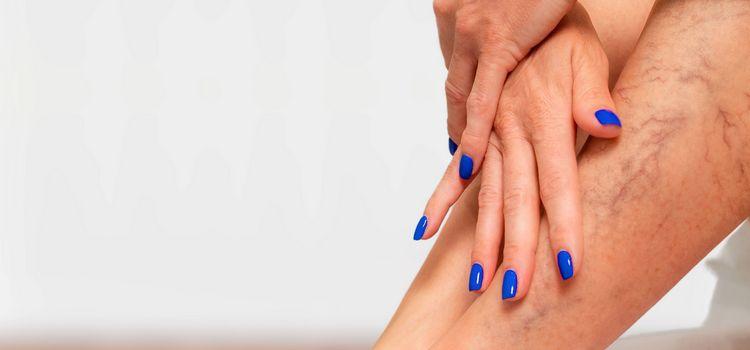 Visszeres láb: nem kizárólag esztétikai probléma