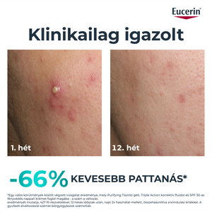 gl_en_euc_yoda_acne_dermopure_triple_action_66862_sv_v0_before_after.png