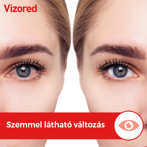 Vizored 0,5 mg/ml oldatos szemcsepp 10ml - Kép 5